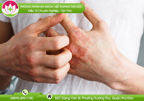 Cách Chữa Bệnh Giang Mai Tại Nhà