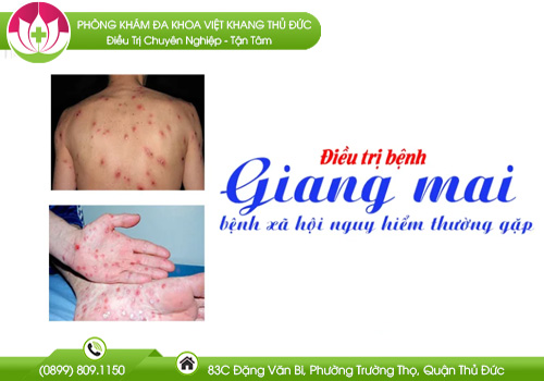 Chi Phí Chữa Bệnh Giang Mai Có Đắt Không