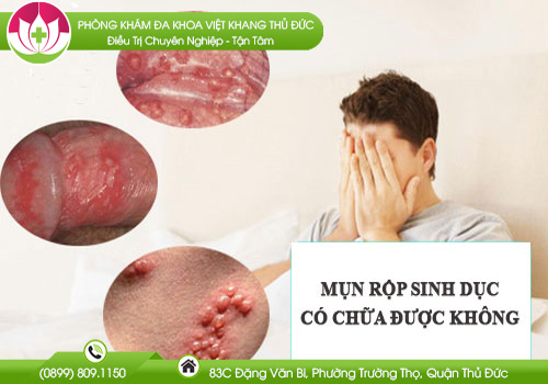 Mụn Rộp Sinh Dục Có Chữa Được Không