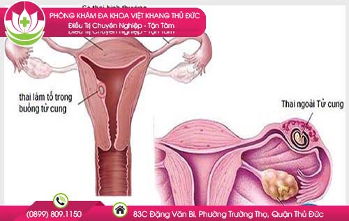 thai-4-tuan-da-vao-tu-cung-chua