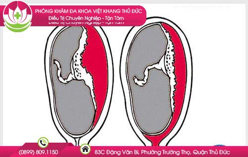 tien-san-giat-co-nguy-hiem-khong