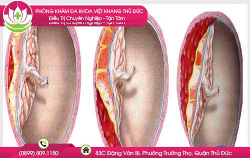 tien-san-giat-la-gi-cach-phong-tranh-tien-san-giat