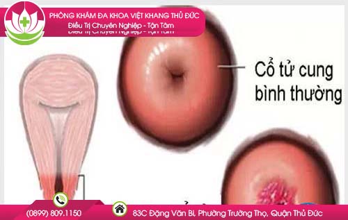 xet-nghiem-pap-smear